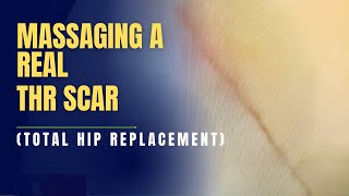 5-Minute THR Total Hip Replacement Scar Massage for FAST Recovery!