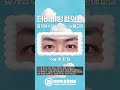 #더비비성형외과 👁눈의 인상을 근본적으로 디자인