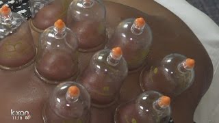 Cupping: Not just for professional athletes