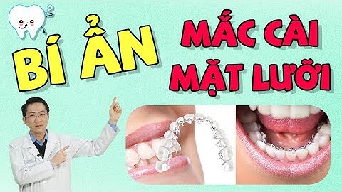 Mắc Cài Mặt Lưỡi | Niềng Răng Mắc Cài Mặt Lưỡi | Niềng Răng | Nam Bùi Vinalign