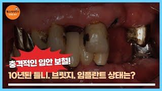 충격적인 입안 보철! 10년 된 틀니, 브릿지, 임플란트 상태는?