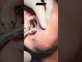 MARPE/MSE for Maxillary Skeletal Expansion #orthodontics #alignersforteeth #invisaligntreatment