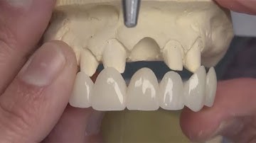 Chairside Live Episode 28: Ovate Pontic Sites With BioTemps® Provisionals