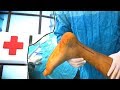 Achilles Tendon Injury  (Surgical Technique)