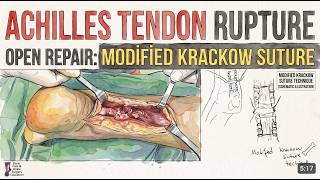 Achilles Tendon Injury  (Surgical Technique)