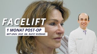 79 JAHRE & dieses Ergebnis?! 😱 Deep Plane Facelift nach 1 Monat