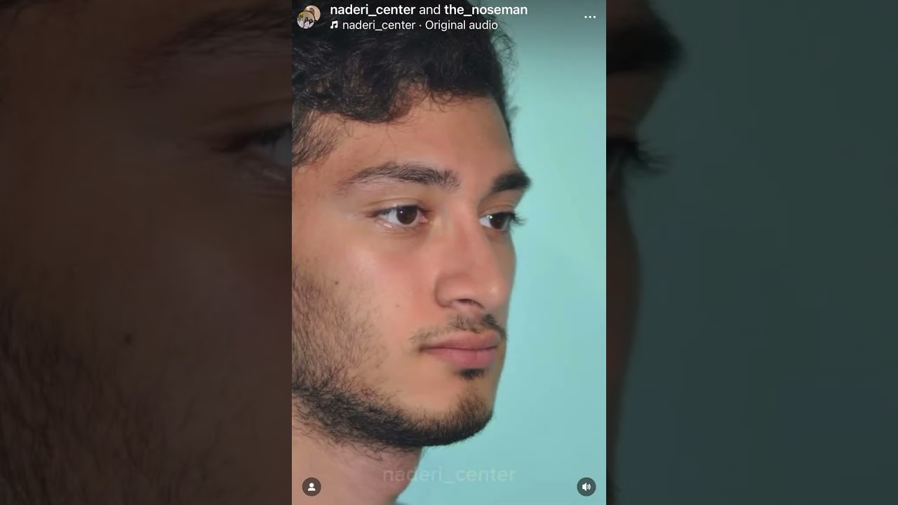 Rhinoplasty patient of Dr. Shervin Naderi, before and after video