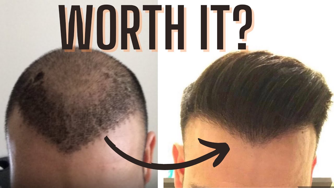 Is Getting A Hair Transplant Worth It? YouTube