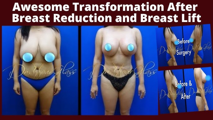 best decision I ever made❤️‍🩹 #breastreduction #beforeandafter #bestd