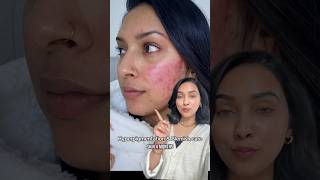 I hope this works wonders for you as it did for me💗 *not sponsored* #hyperpigmentation