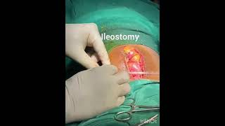 Typhoid perforation after Resection and anastomosis in ileo-ileal Intussusception.