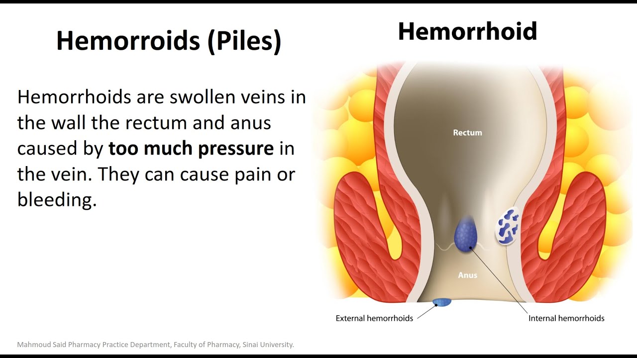 Hemorrhoids - Piles البواسير