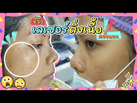 รีวิว เลเซอร์ติ่งเนื้อครั้งแรก! ผิวหลังทำแล้ว เป็นยังไงบ้าง? | Licktga