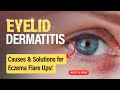 Eyelid Dermatitis Uncovered: Causes and Solutions