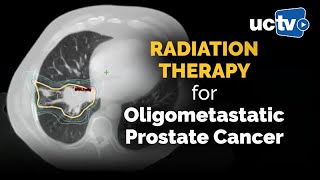 Radiation Therapy for Oligometastatic Prostate Cancer