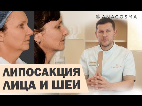 ЛИПОСАКЦИЯ ЛИЦА, ЩЕК, ВТОРОГО ПОДБОРОДКА 🔥  КОГДА МОЖНО, А КОГДА - НЕТ❓ПРОКОЛЫ☝🏻РЕАБИЛИТАЦИЯ