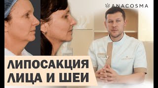 ЛИПОСАКЦИЯ ЛИЦА, ЩЕК, ВТОРОГО ПОДБОРОДКА   КОГДА МОЖНО, А КОГДА  НЕТ❓ПРОКОЛЫ☝РЕАБИЛИТАЦИЯ