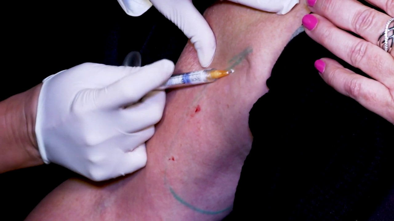 Banner for Radiesse Improves Inner Arm Crepiness