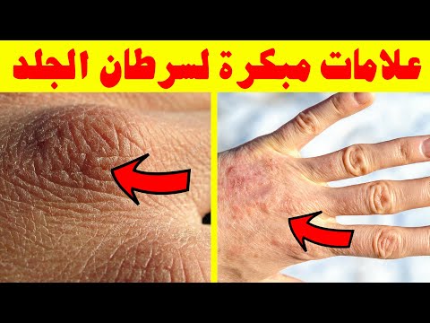 عشر علامات قاتلة من سرطان الجلد تحتاج إلى وقفة في وقت مبكر! أعراض سرطان الجلد المبكرة