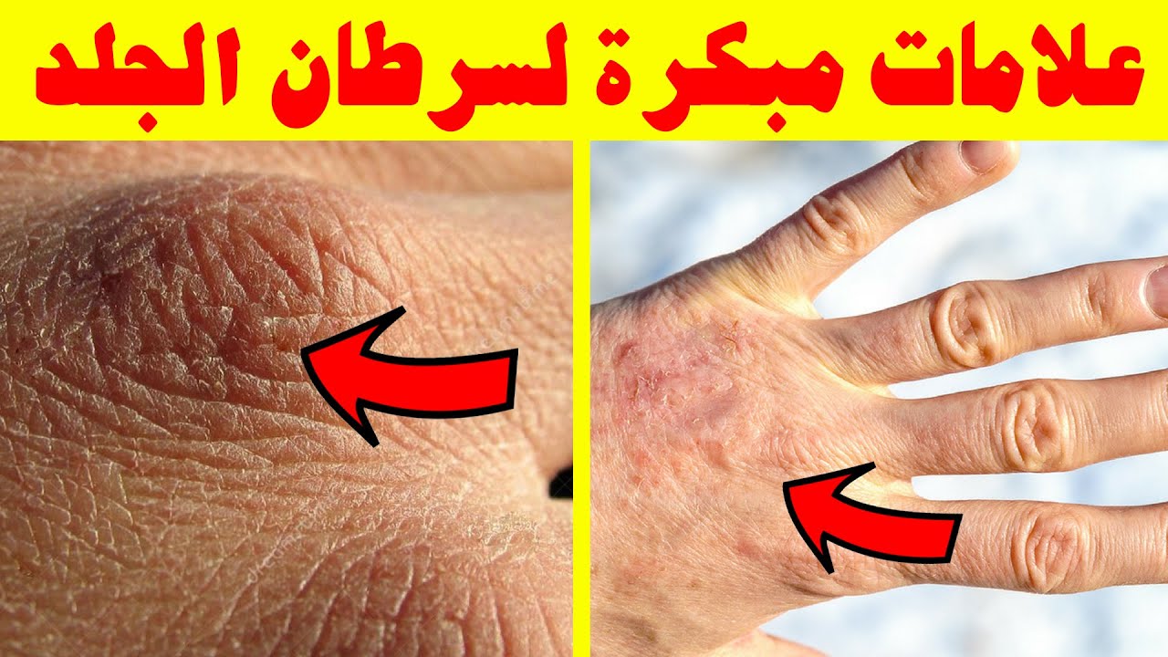 عشر علامات قاتلة من سرطان الجلد تحتاج إلى وقفة في وقت مبكر! أعراض سرطان  الجلد المبكرة - YouTube