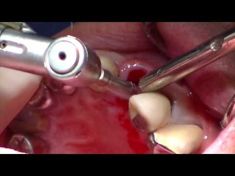 Atraumatic Extraction of a Non-Restorable Maxillary Lateral Incisor