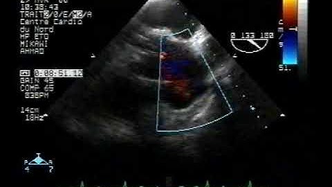 echocardiogram tee:localized dissection2/3 of the ascending aorta colour doppler