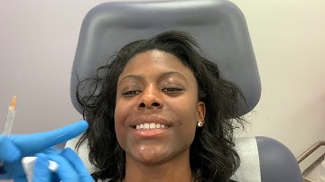 Dr. Patel treats nasolabial folds using Restylane Defyne and a microcannula