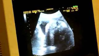 2009 12 21 Baby3 Sonogram.mp4