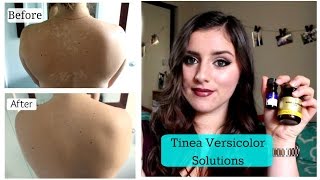 Tinea Versicolor, SOLUTIONS!! |TNBeauty94 screenshot 1