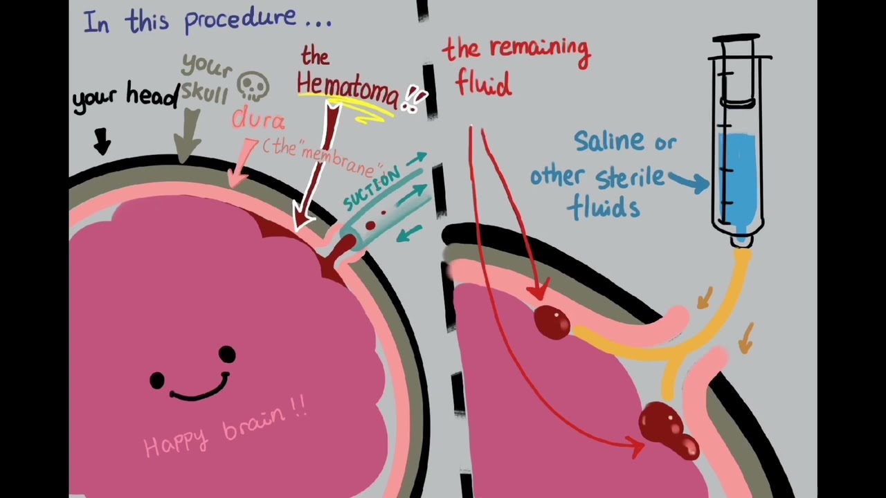 How Do Neurosurgeons Treat Subdural Hemorrhages?