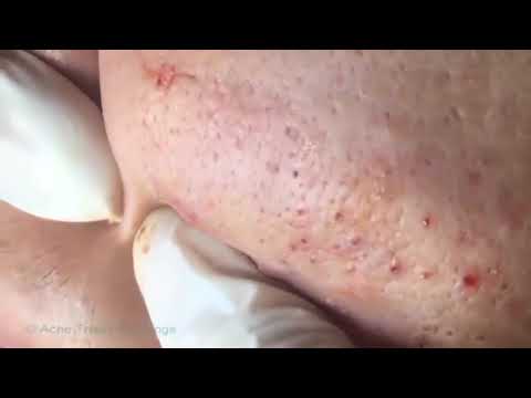 How to Removal Cystic Acne ,Blackheads & Whiteheads on the face Easy   Acne Treatment Vlogs  