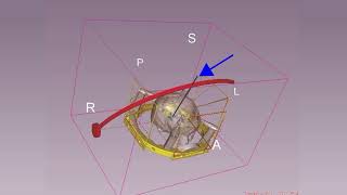 Neurosurgery Frame based Navigation [A Phasor eNLIghTeN educational series video.]