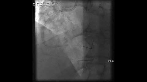 Complex PCI for RCA CTO with bifurcation at distal cap video 16