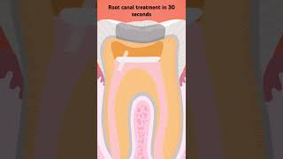 #rootcanaltherapy #DentalSurgery#3DAnimation #ToothReplacement #Dentistry#dentalreels#viral#neet