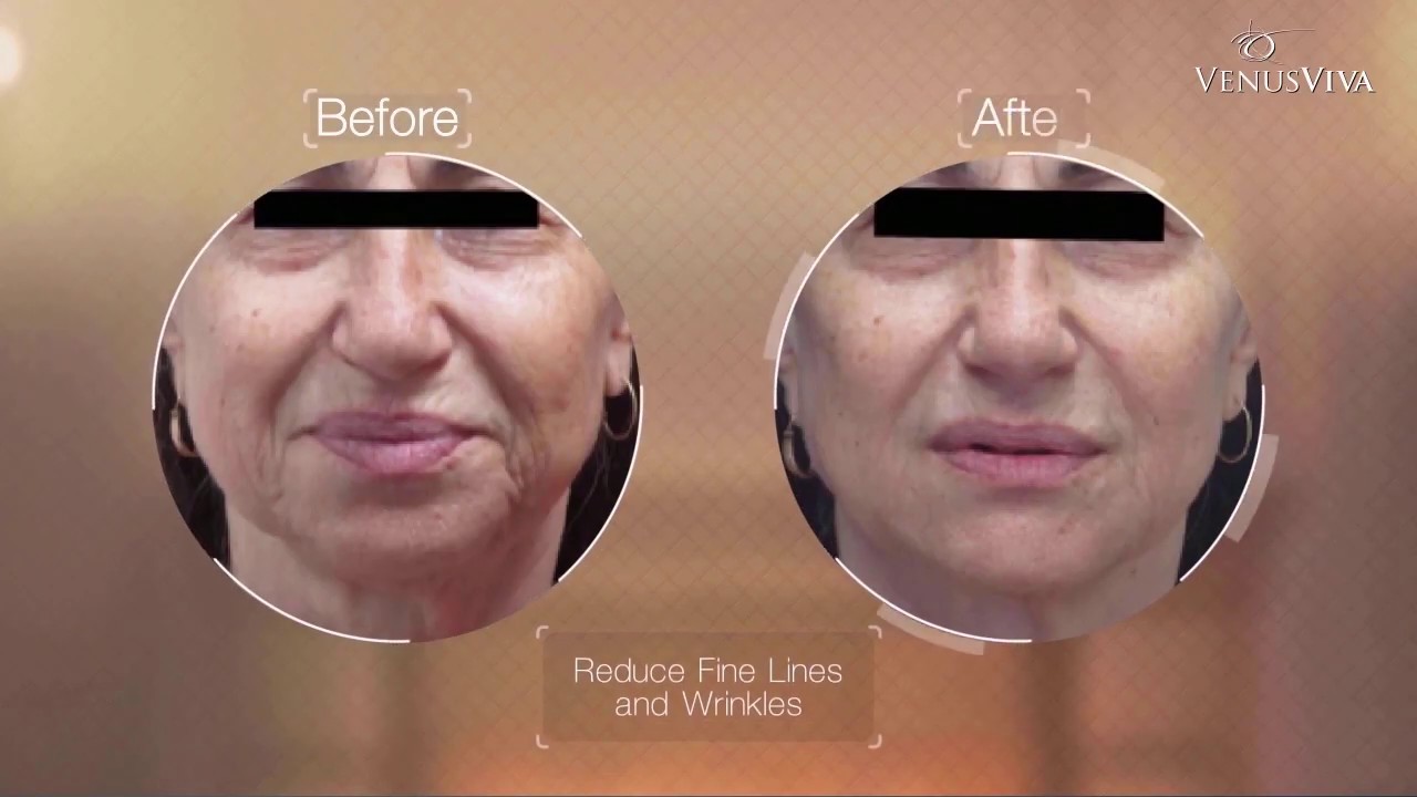 Venus Viva | Skin resurfacing system