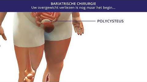 Obesitas chirurgie vrouw