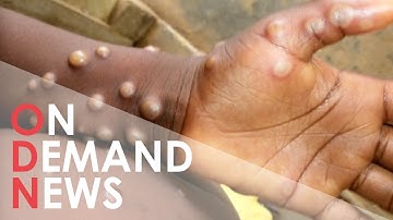 Monkeypox: EVERYTHING You Need to Know About New Virus