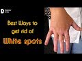 How to treat white spots on the skin? - Dr. Rasya Dixit