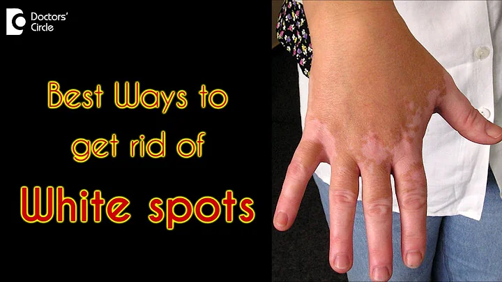 How to treat white spots on the skin? - Dr. Rasya Dixit - DayDayNews