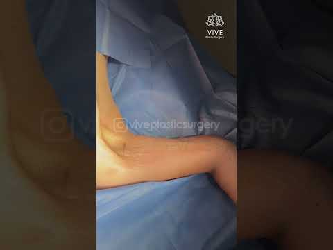 Upper Body Harmony✨Breast Lift & Braquioplasty at Vive Plastic Surgery #tijuana 🤩