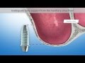 Sinus floor elevation (Dental Animation)