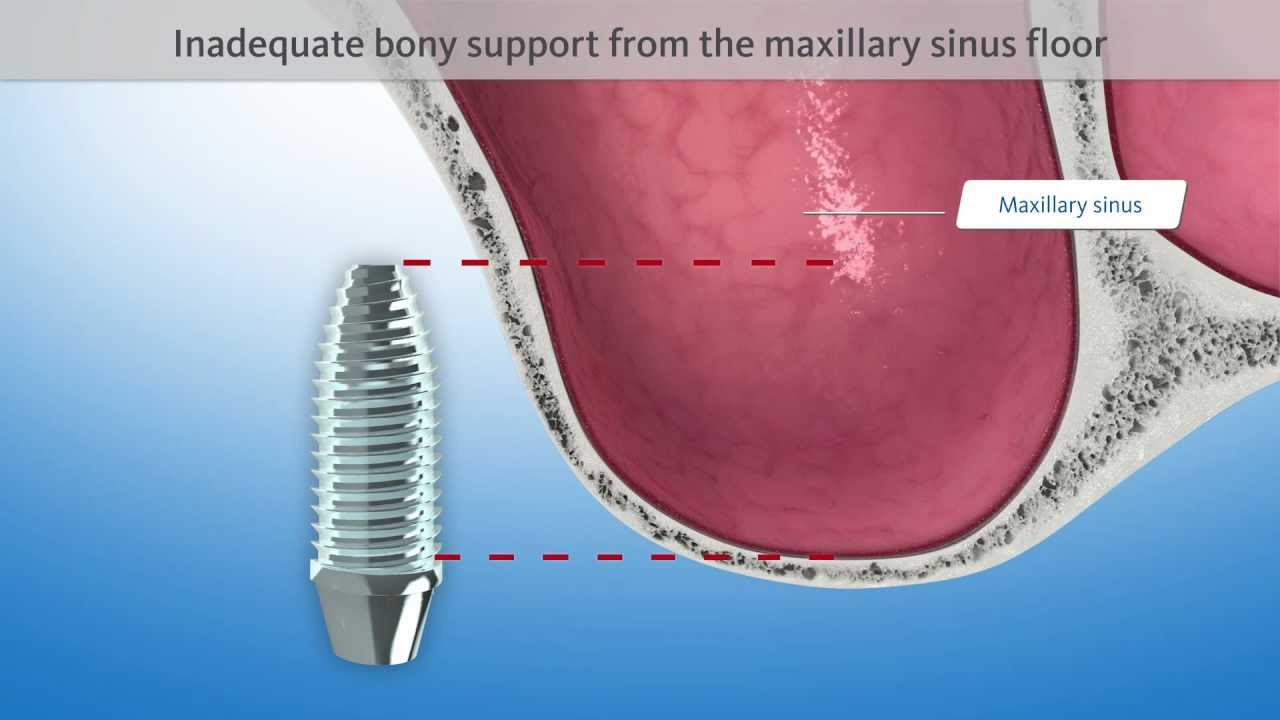 Sinuslift / Sinusbodenelevation (3D-Animation Zahnmedizin)