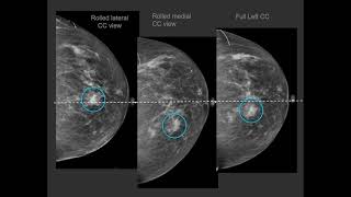 Diagnostic mammography