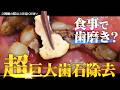 超巨大歯石除去‼️なぜこんなについたのか