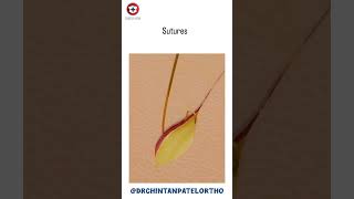 Invisible Stiches Technique: Subcuticular suture (Vertical Mattress) #MedicalEducation #WhiteCastle