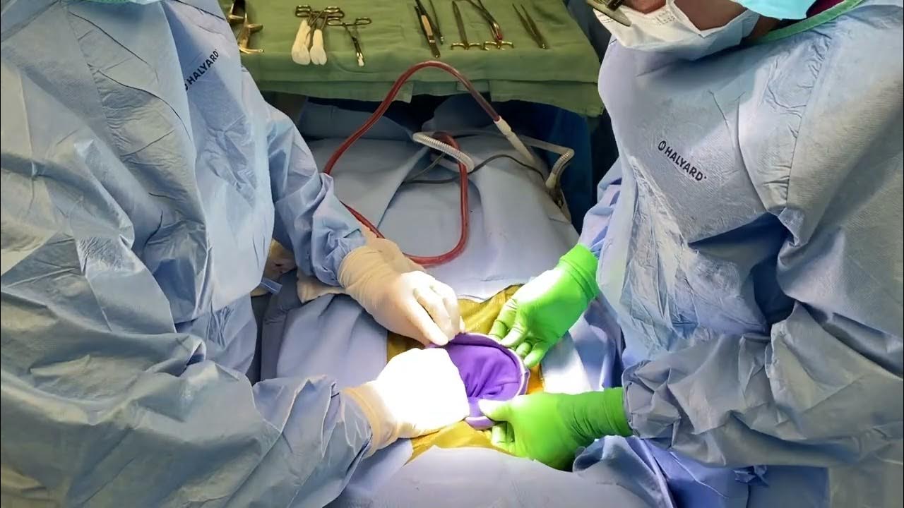 Alexis Orthopedic Retractor used in ALIF procedure YouTube