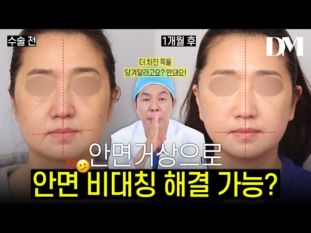 안면거상으로 얼굴 비대칭 개선 할 수 있을까?🤔 #안면거상 #안면비대칭 #얼굴비대칭