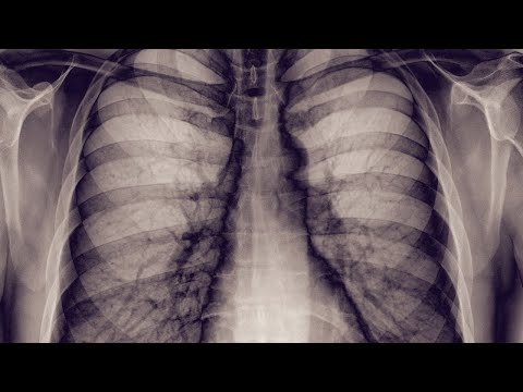 Wideo: Obrazowanie Wiązką Jonów Helu Do Radioterapii Jonowej Sterowanej Obrazem