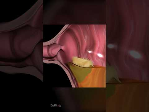 ASMR: Acid Reflux