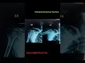 PHILOS PLATE, proximal humerus fracture